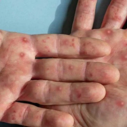 Colombia confirma segundo caso de viruela del mono clado 1b en Bogotá